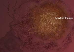 Amyloid plaques are sticky buildup which accumulates outside nerve cells, or neurons, which may hold the key for preventing dementia.