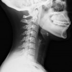 Lateral_neck_X-ray_of_whiplash