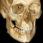 3D_CT_of_bilateral_mandible_fracture