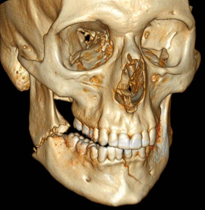 3D_CT_of_bilateral_mandible_fracture.jpg