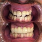 Anterior_crowns_of_Emax