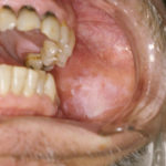 Leukoplakia02-04-06