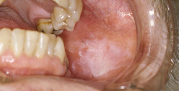 Leukoplakia02-04-06