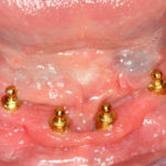 Ballsocket_style_overdenture