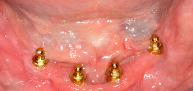 Ballsocket_style_overdenture