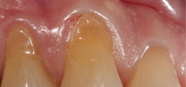 Gum_graft_fig_1