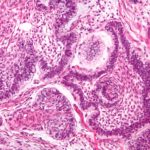 Ameloblastoma_-_high_mag