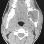 CT_Scan_of_ameloblastoma