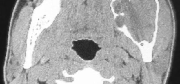 CT_Scan_of_ameloblastoma