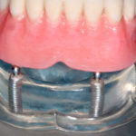 Overdenture - ball attachments