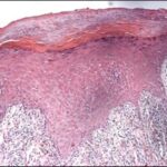 Lichen Planus -histopathology