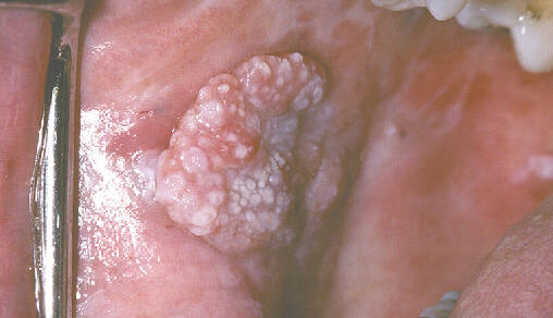Leukoplakia , Verrucous