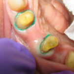 gingival retraction cord