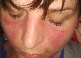 Lupus (SLE)