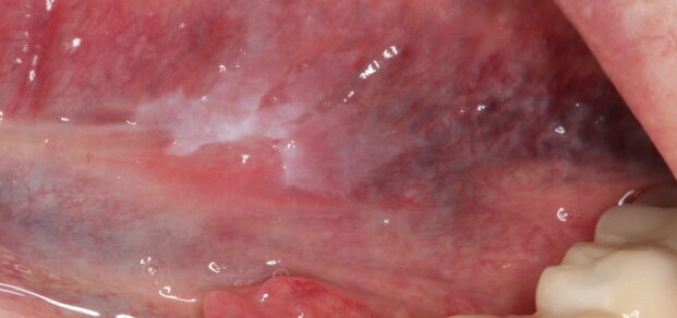 Severe_dysplasia