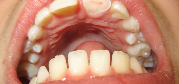 Fractured tooth