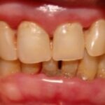 Periodontal disease
Periodontitis