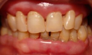 Periodontal disease
Periodontitis