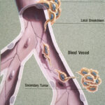 Metastasis_illustration