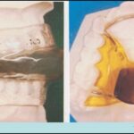 Mandibular advancement device