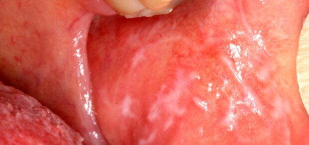 Lichen_planus