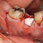 tooth Socket_preservation_complete