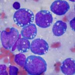 Burkitt lymphoma, touch prep, Wright stain