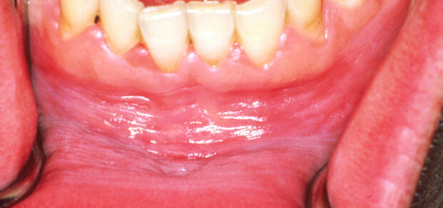 Leukoplakia