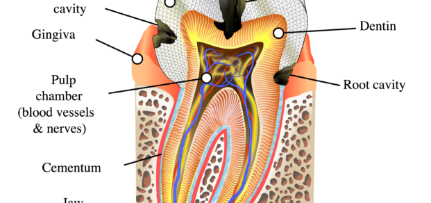 tooth diagramme, caries