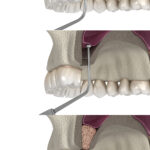 Sinus Lift