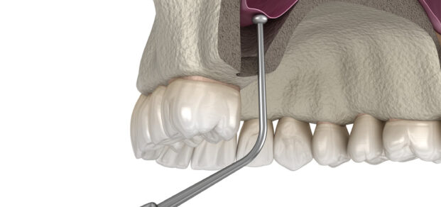 Sinus Lift