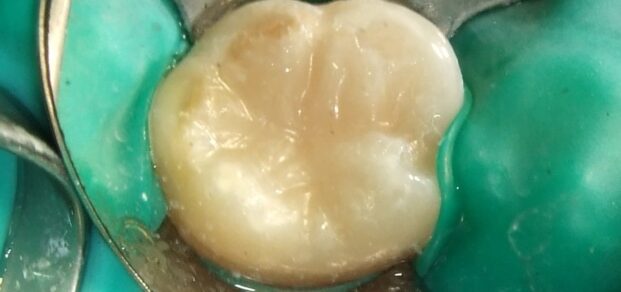 Composite filling