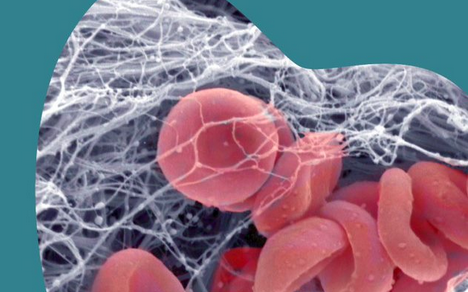 SDCEP- Anticoag-platelets 2022