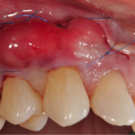 Gingival graft