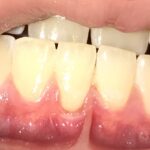 Gingival recession