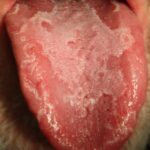 geographic tongue