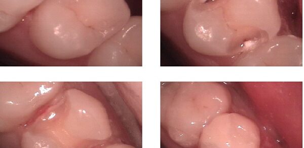 Dental_Restoration
