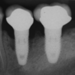 Periimplantitis_progression_over_5_years_in_heavy_smoker