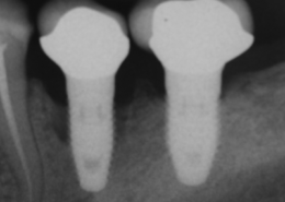 Periimplantitis_progression_over_5_years_in_heavy_smoker