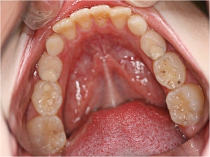 Photograph of carious teeth