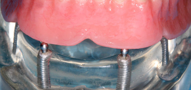 Overdenture - ball attachments