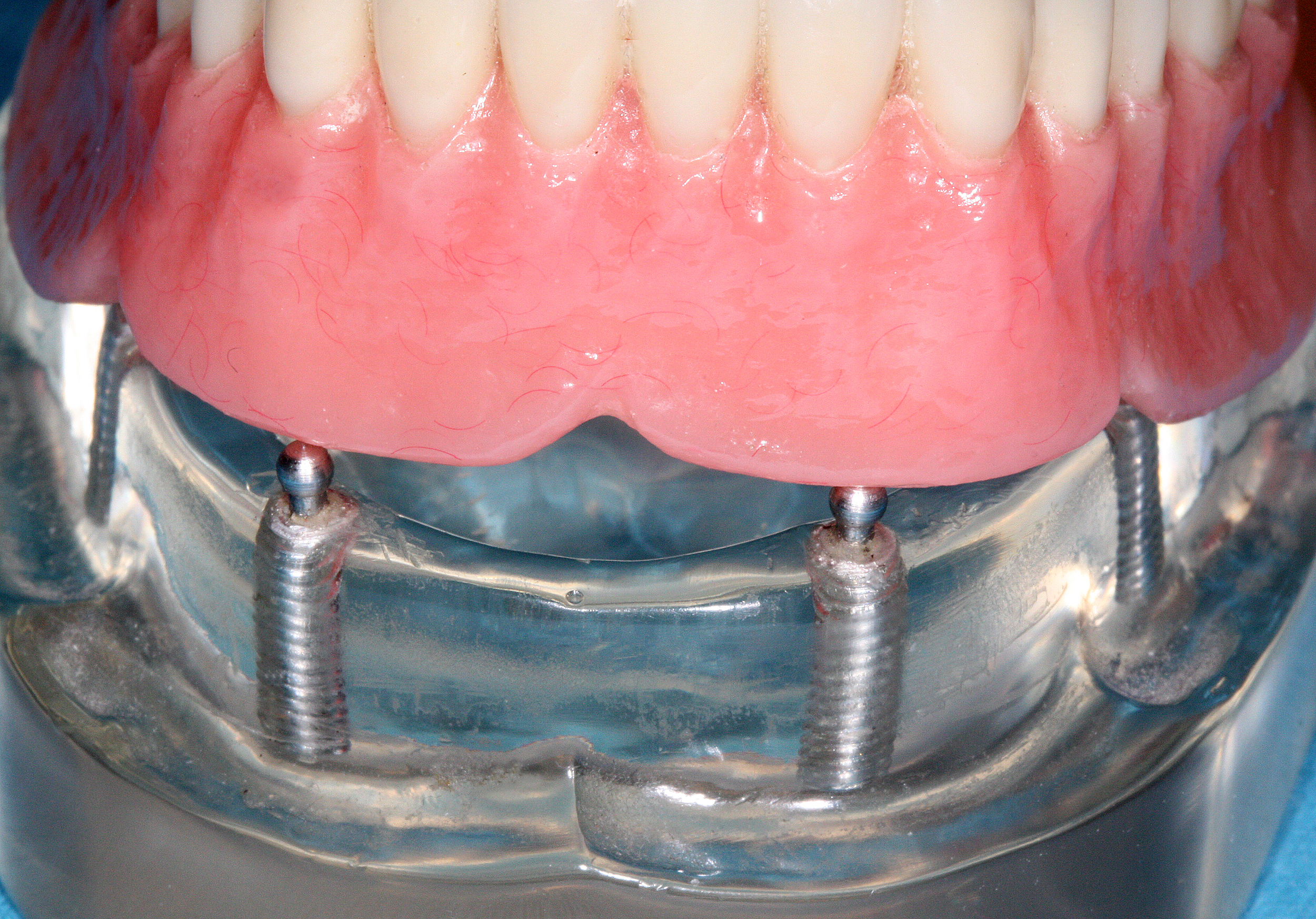 Overdenture - ball attachments