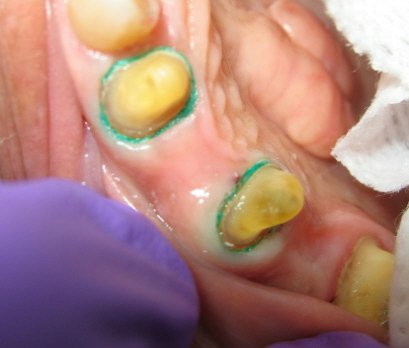 gingival retraction cord