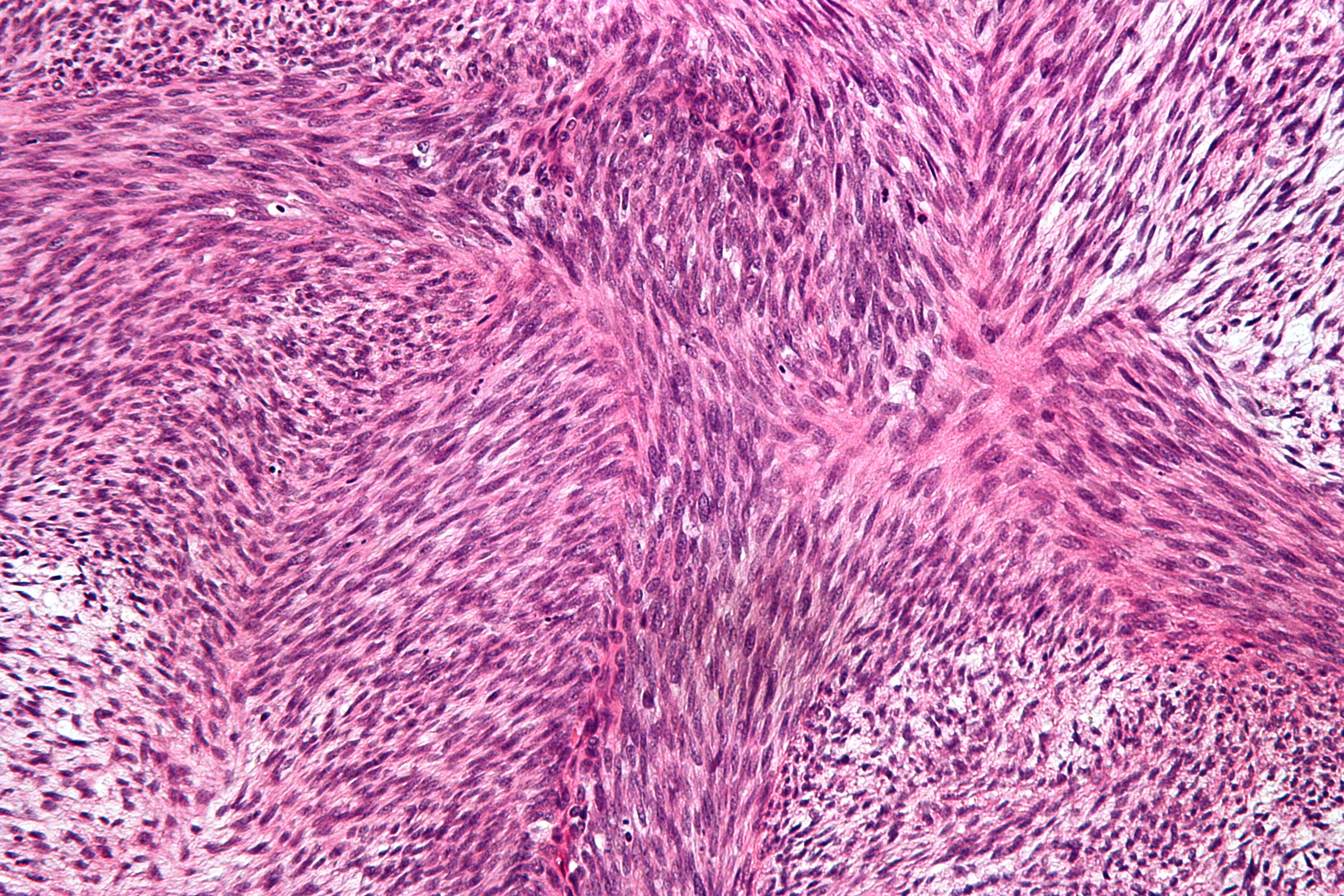 Sarcoma. fibrosarcoma