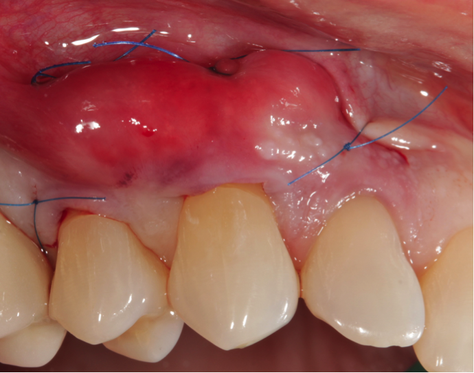Gingival graft